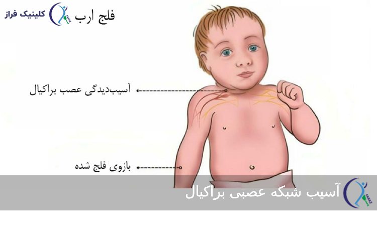 آسیب شبکه عصبی براکیال