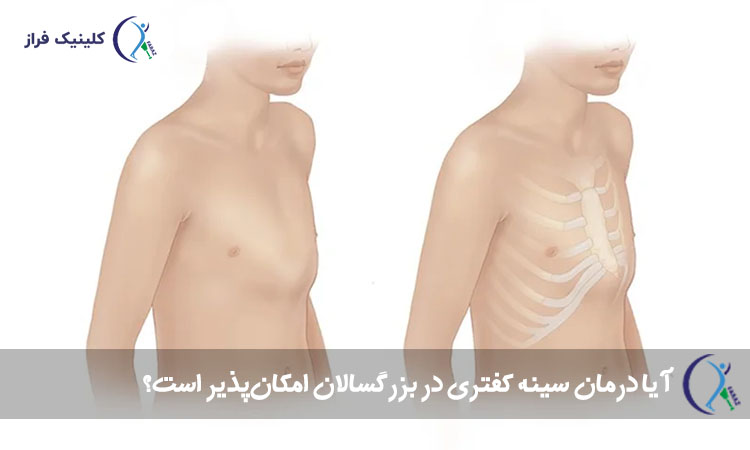 آیا درمان سینه کفتری در بزرگسالان امکان‌پذیر است؟

