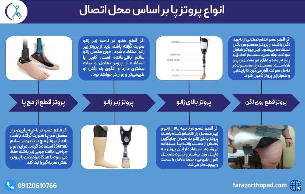 انواع پروتز پای مصنوعی بر اساس محل اتصال