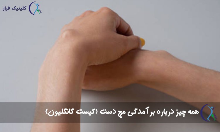 کیست مچ دست