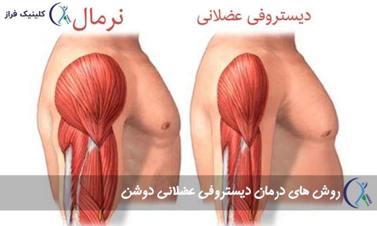 درمان دیستروفی عضلانی دوشن