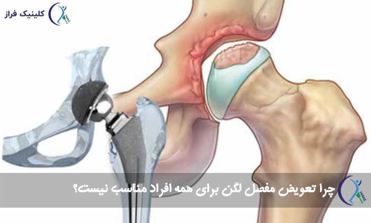تعویض مفصل لگن