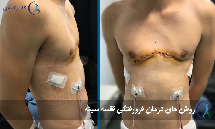 درمان فرورفتگی قفسه سینه