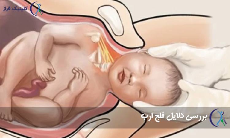علت فلج ارب