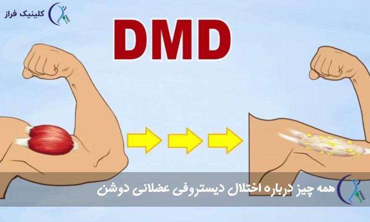 اختلال دیستروفی عضلانی دوشن