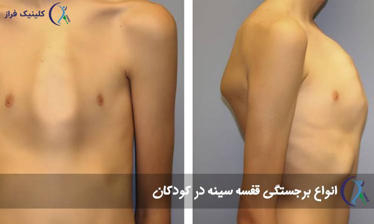 انواع برجستگی قفسه سینه در کودکان