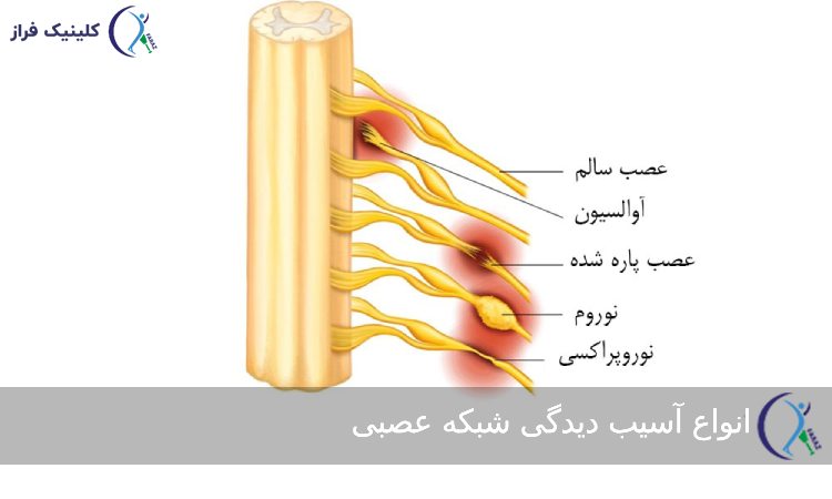 انواع آسیب دیدگی فلج ارب