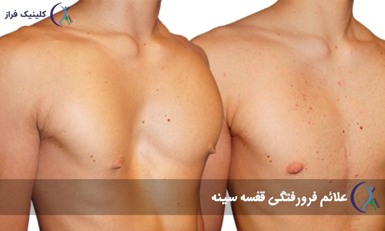علائم فرو رفتگی قفسه سینه