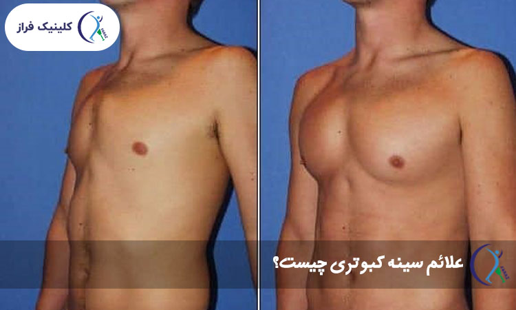 علائم سینه کبوتری چیست؟