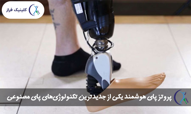 پای مصنوعی هوشمند