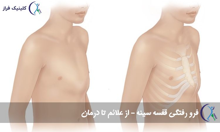 فرو رفتگی قفسه سینه