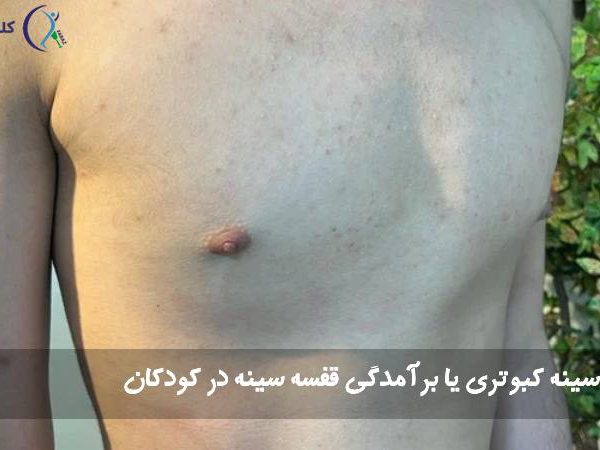 سینه کبوتری یا برآمدگی قفسه سینه در کودکان