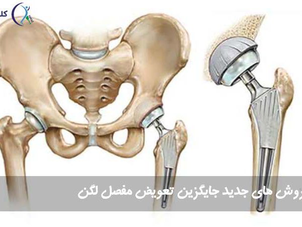 راه جایگزین تعویض لگن