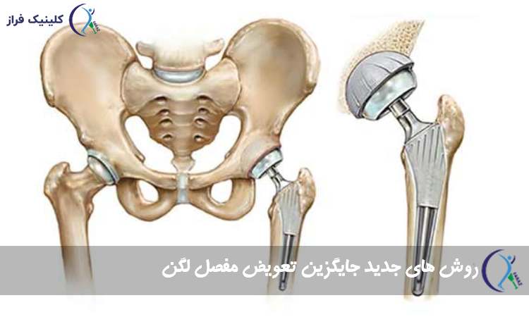 راه جایگزین تعویض لگن