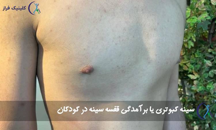 سینه کبوتری یا برآمدگی قفسه سینه در کودکان