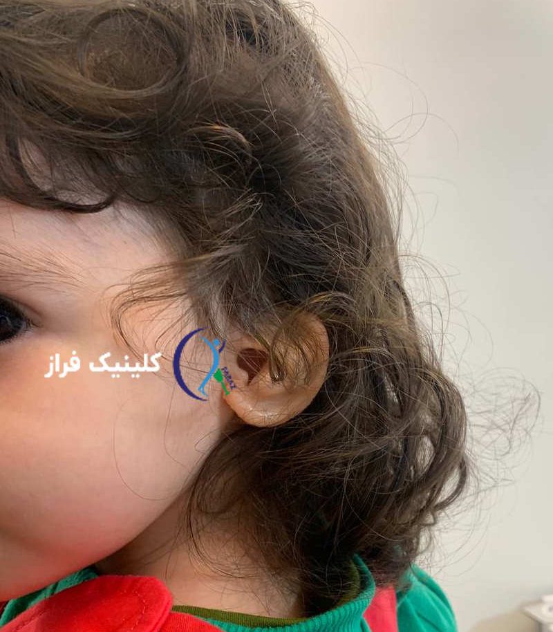 پروتز گوش برای آرتزی گوش کودکان
