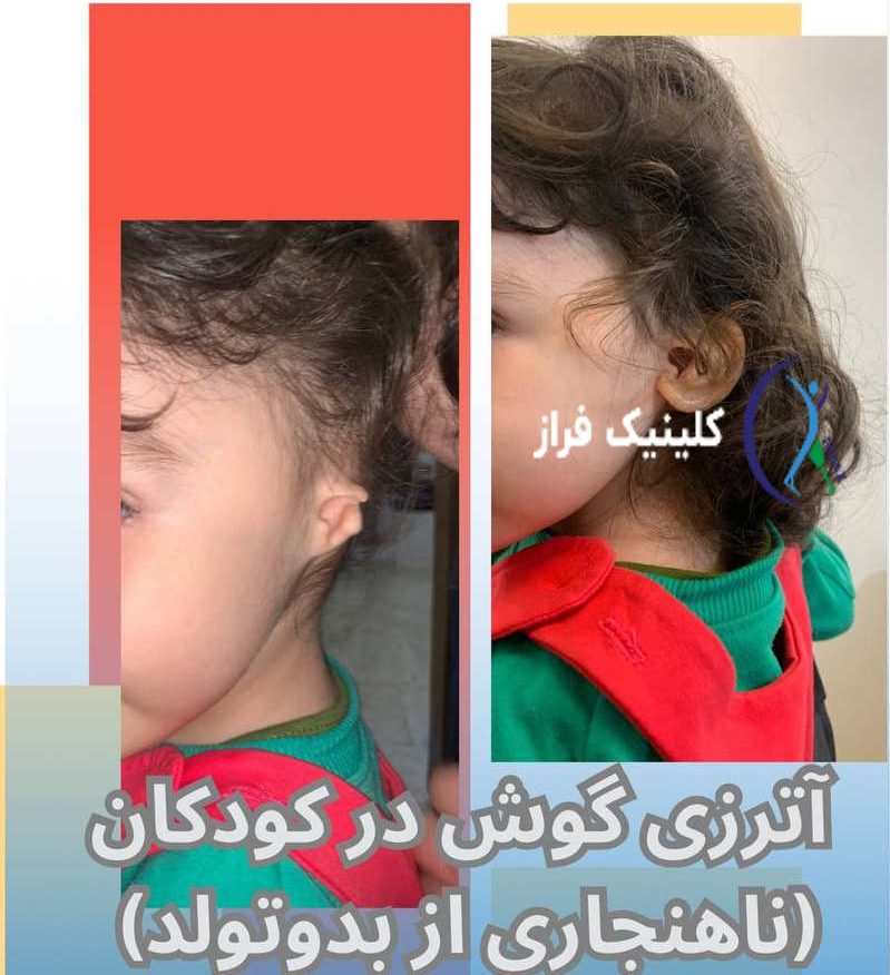 ارتزی گوش در کودکان