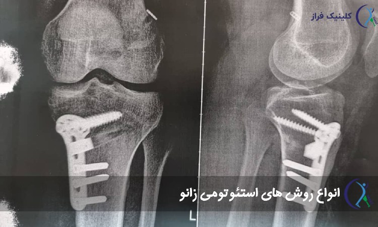 انواع روش های استئوتومی زانو