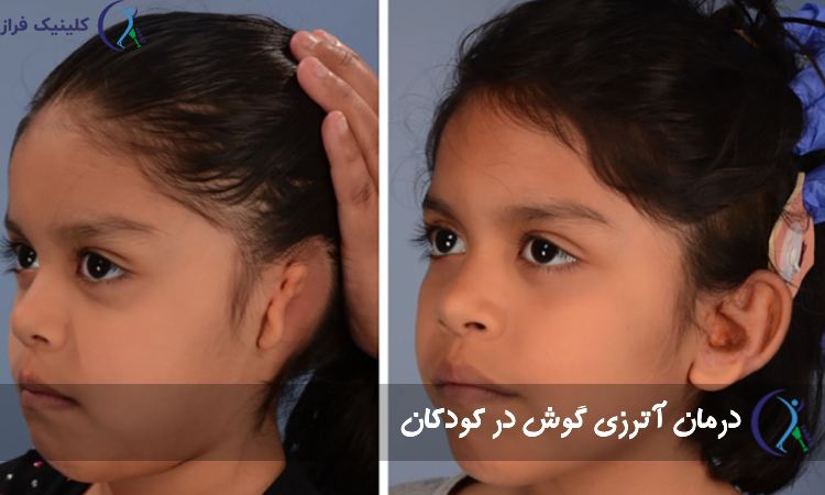 درمان عدم تشکیل لایه گوش کودکان