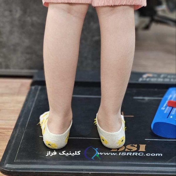 تاثیر کف پای صاف بر زانو و مچ پا
