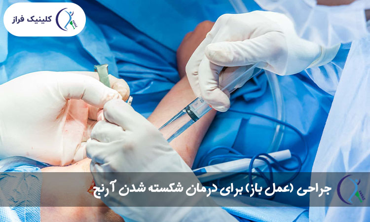 جراحی (عمل باز) برای درمان شکسته شدن آرنج