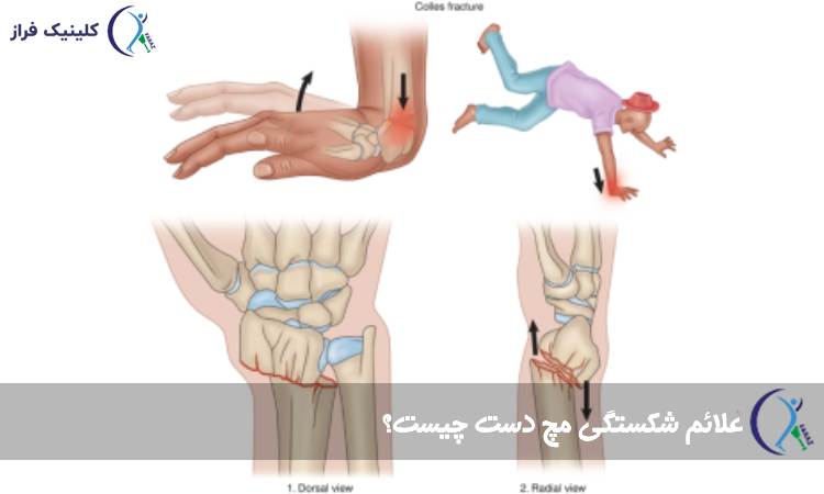 علائم شکستگی مچ دست