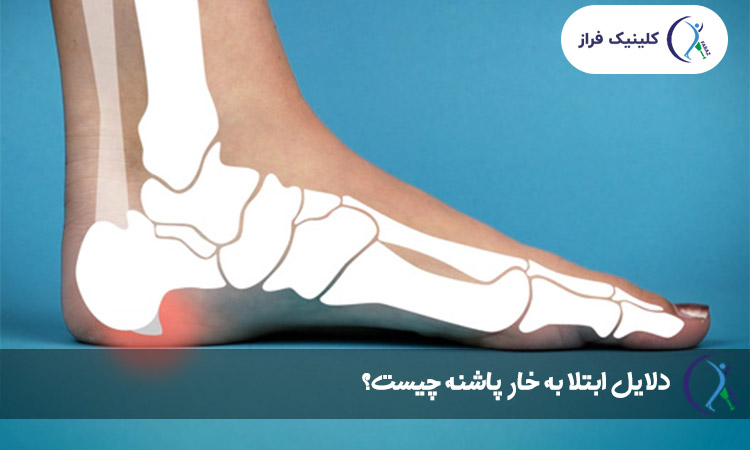 دلایل ابتلا به خار پاشنه