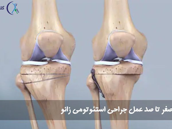جراحی استئوتومی زانو