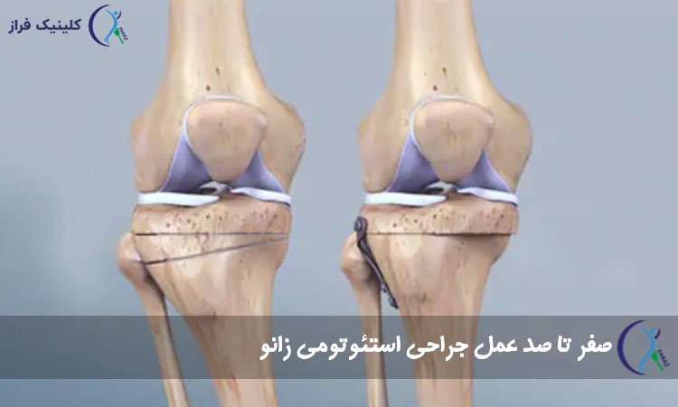 جراحی استئوتومی زانو