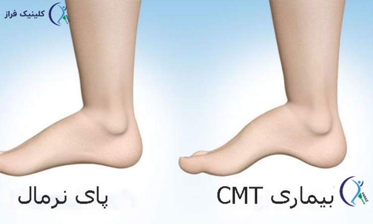 انواع شارکو ماری توث