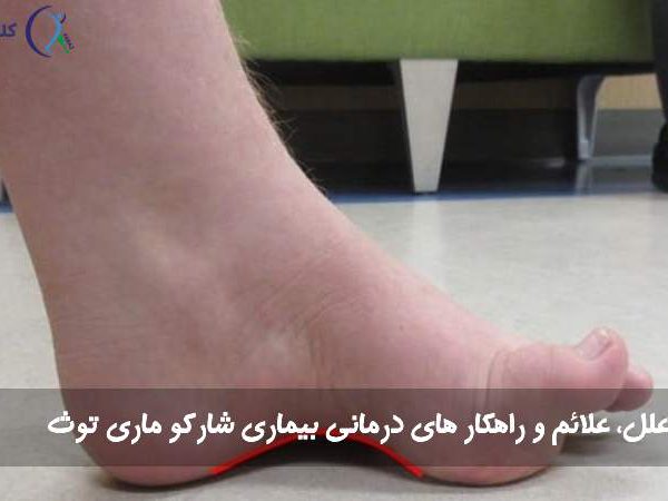 بیماری شارکو ماری توث