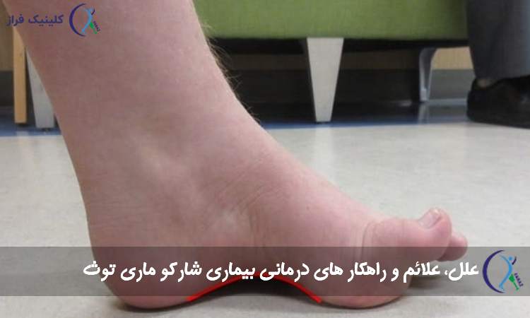 بیماری شارکو ماری توث