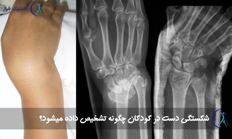 تشخیص شکستگی دست