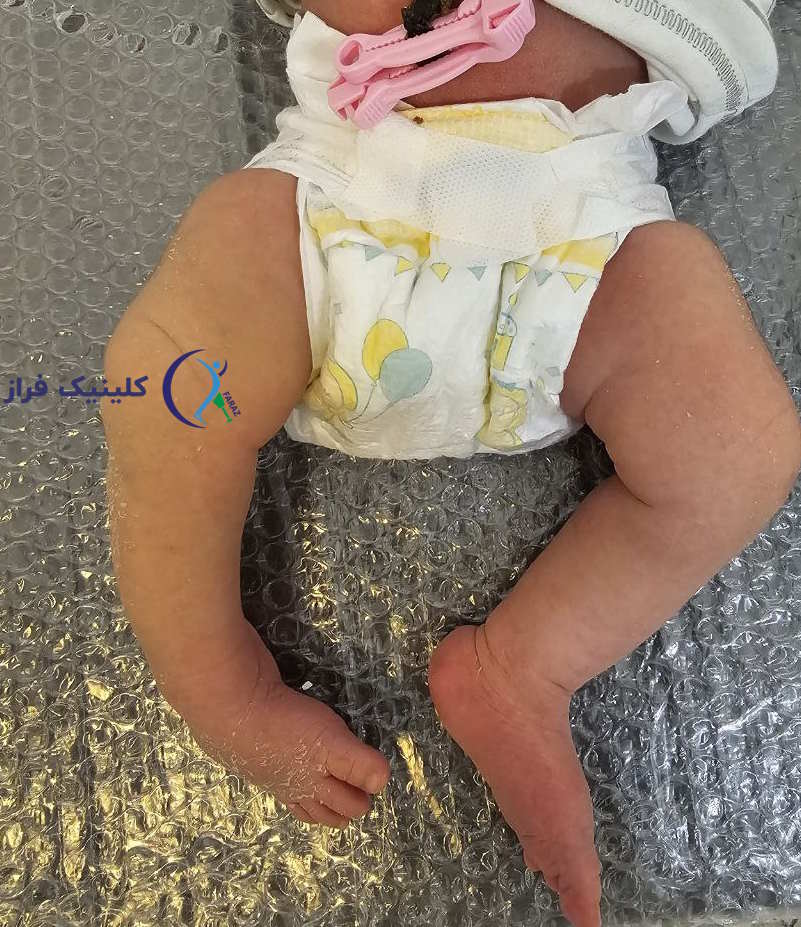 کلاب فوت در پای راست نوزاد