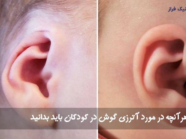 آترزی گوش در کودکان