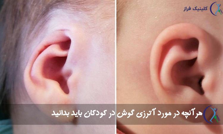 آترزی گوش در کودکان