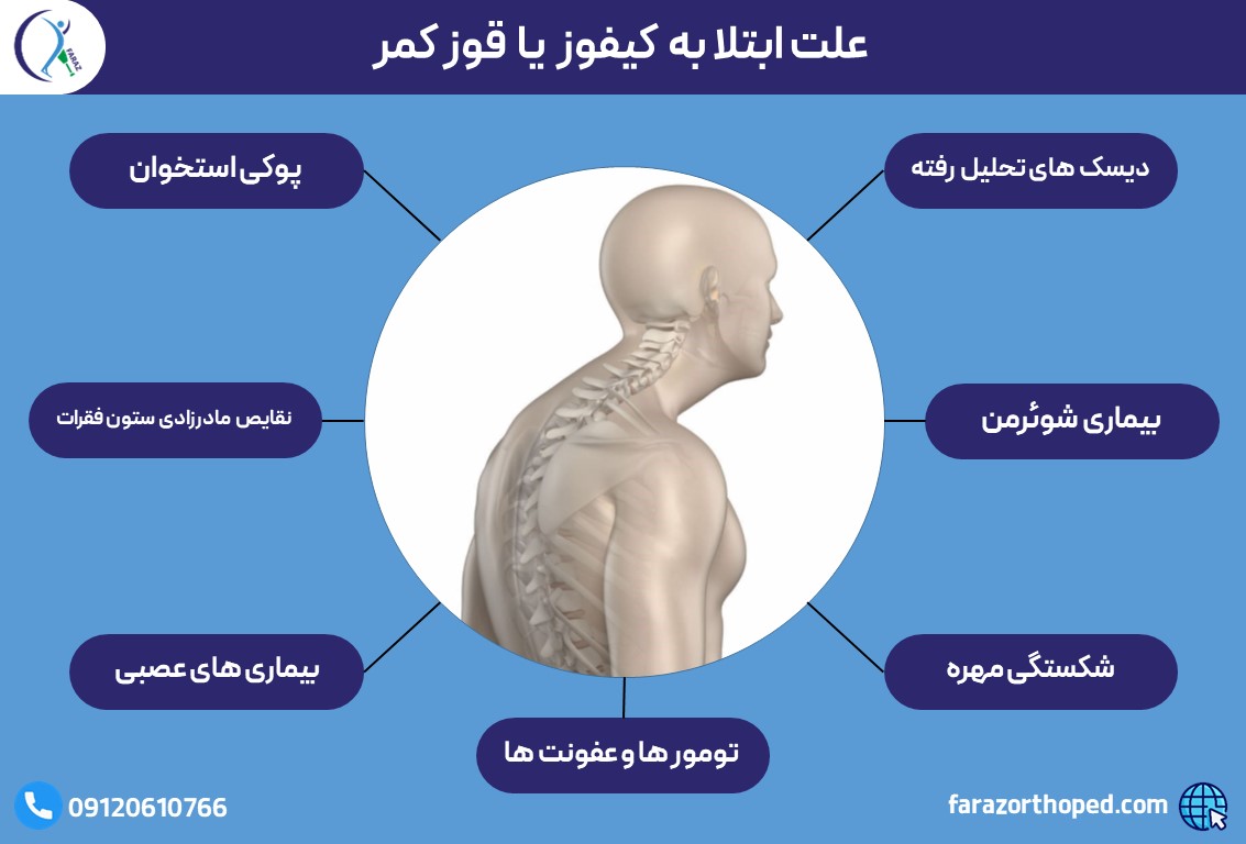 علت ابتلا به کیفوز