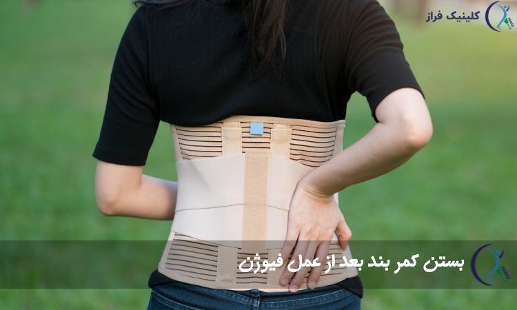 بستن کمر بند بعد از عمل فیوژن