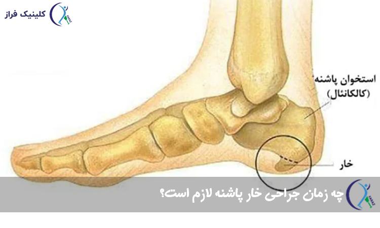 عمل خار پاشنه