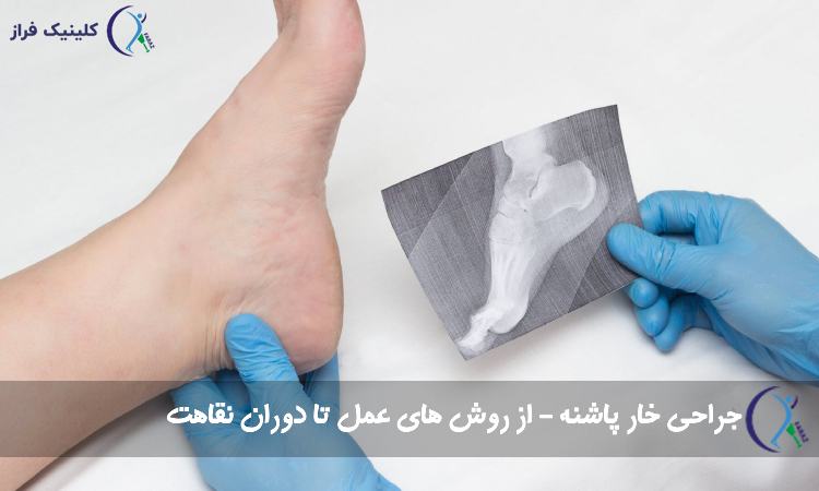 جراحی خار پاشنه
