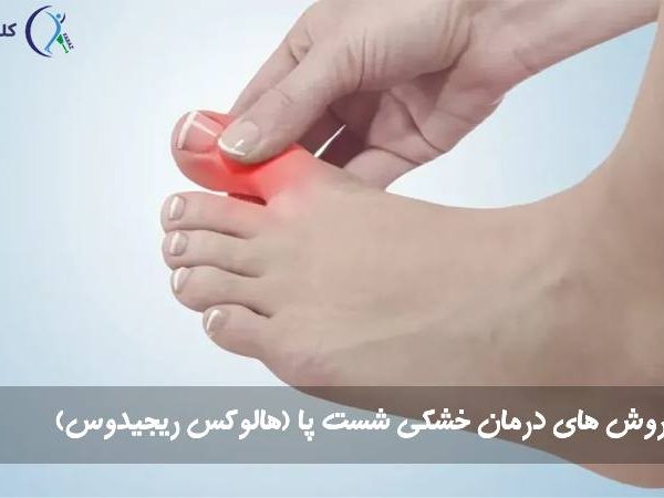 هالکوس ریجیدوس