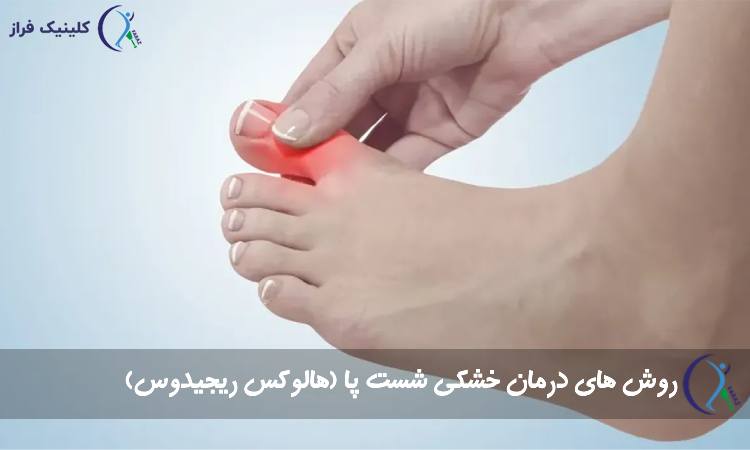 هالکوس ریجیدوس