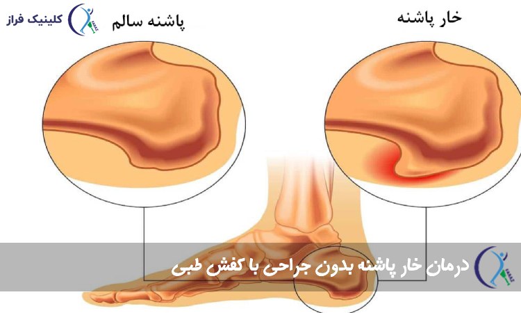 ویژگی های کفش درمان خار پاشنه