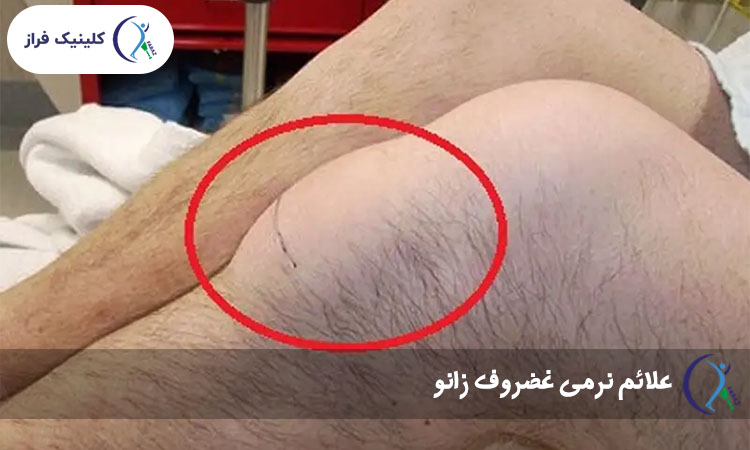 علائم نرمی غضروف زانو