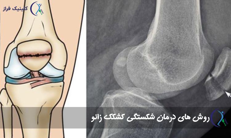 عکس شکستگی کشکک زانو