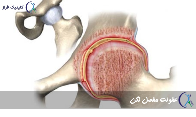عکس عفونت مفصل