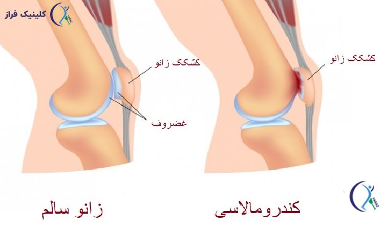 نرمی کشکک زانو