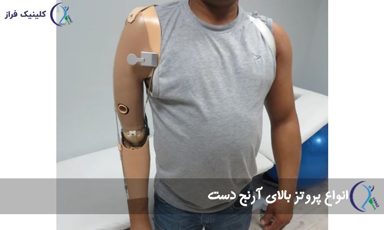 انواع پروتز بالای آرنج دست