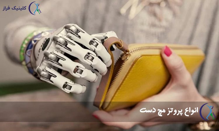 انواع پروتز مچ دست