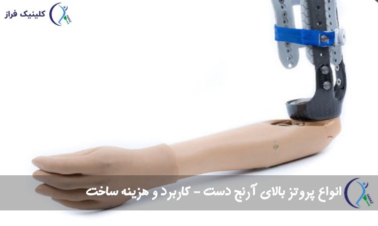 پروتز بالای آرنج دست